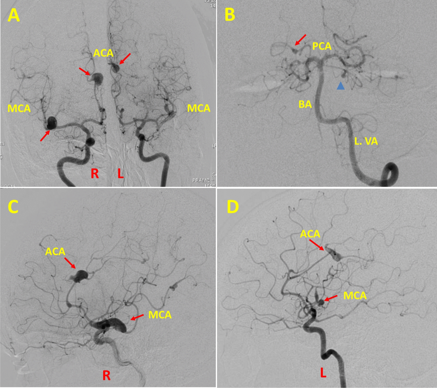 Myxomatous cause of multiple intracranial aneurysms and cognitive decline: a case report