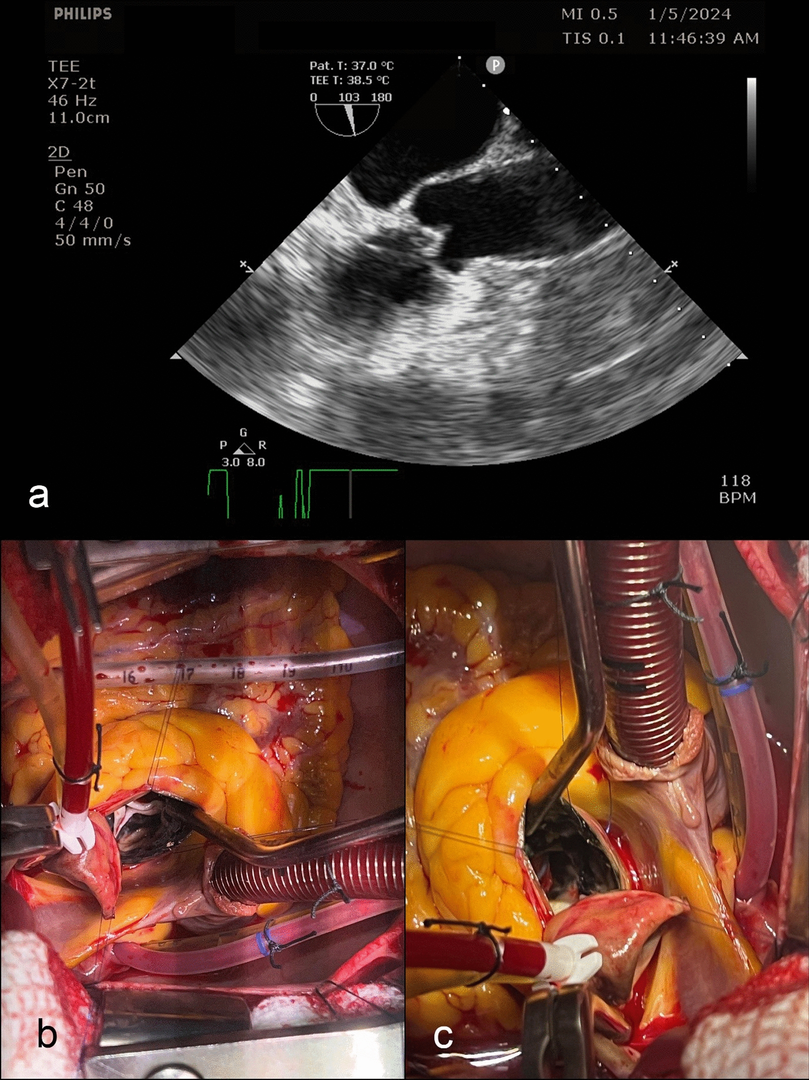 A rare differential diagnosis of aortic stenosis with a black aortic valve: A case report