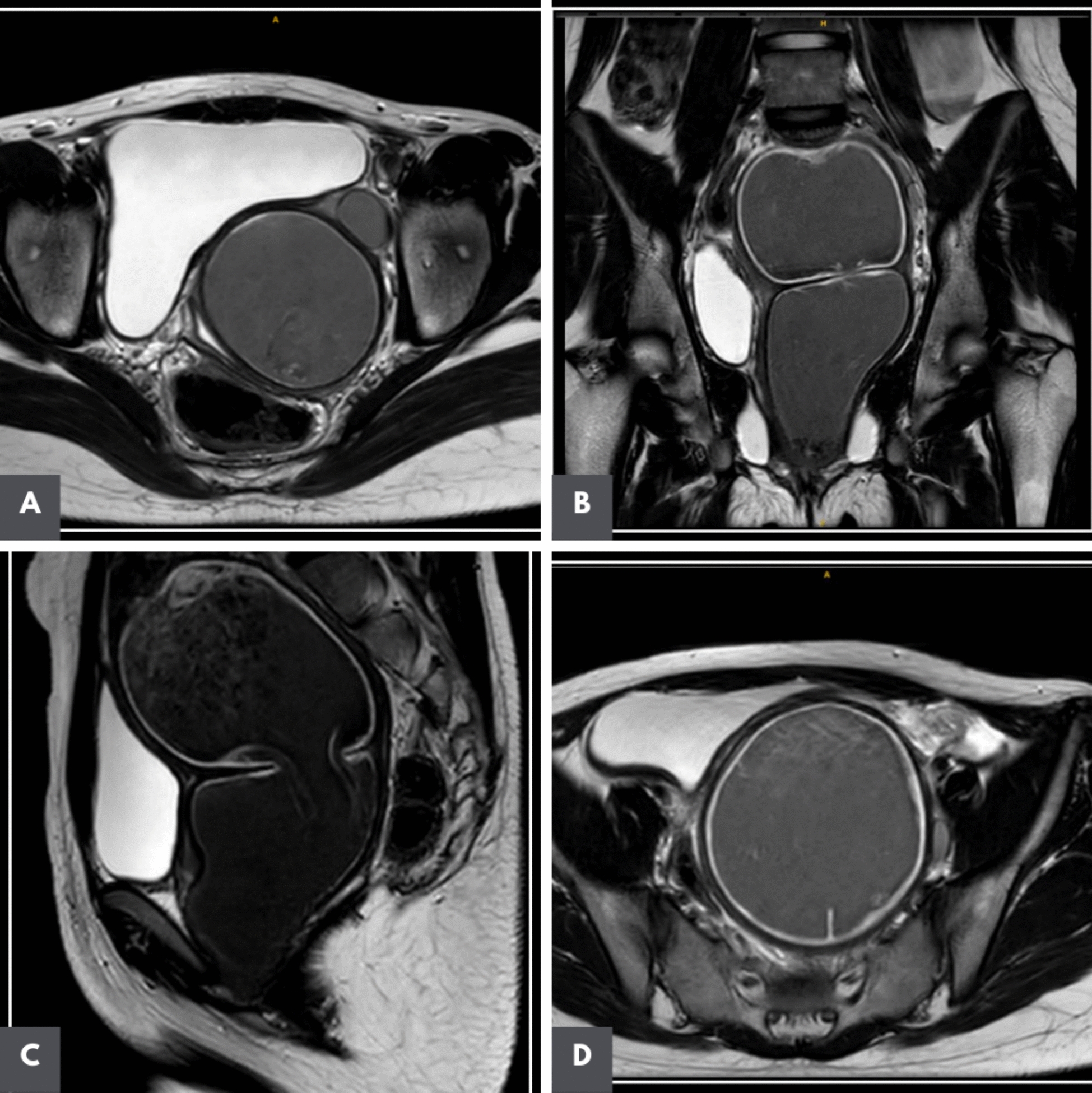 Herlyn Werner Wunderlich Syndrome/OHVIRA: A Rare Case Report with Successful Laparoscopy Assisted Vaginoplasty