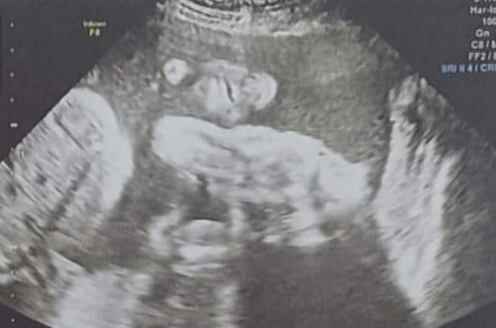Monochorionic–Monoamniotic Twins Discordant for Anencephaly: Story of Expectant Management