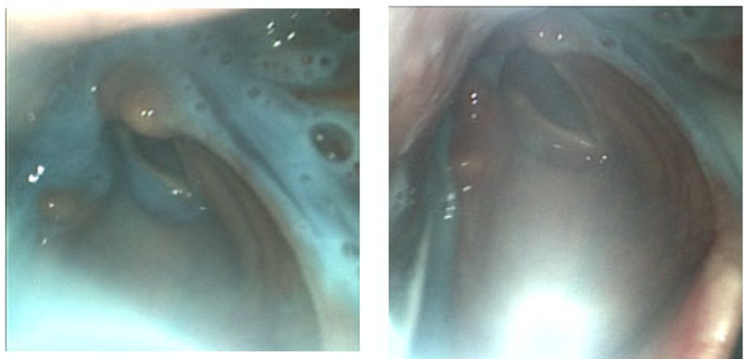 An Unusual Case of Contralateral Hypoglossal and Recurrent Laryngeal Nerve Palsies Following Endotracheal Intubation