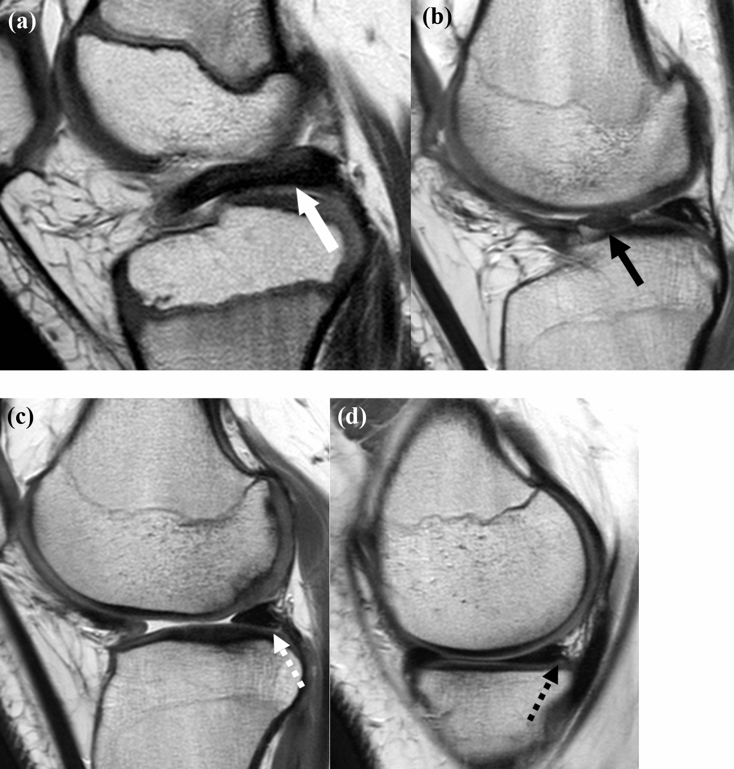 MRI diagnostic performance and strategies for identifying retears in treated pediatric discoid and non-discoid lateral meniscal repairs