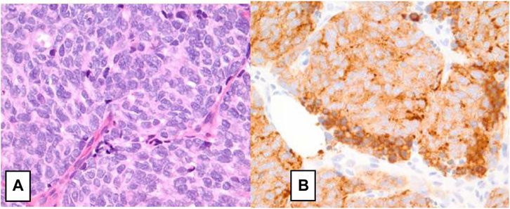 Management of Neuroendocrine Breast Carcinoma (NEBC): Review of Literature