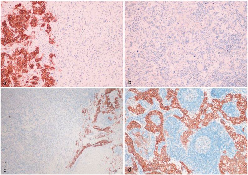 Challenges of FGFR2 Testing in Gastric Cancer