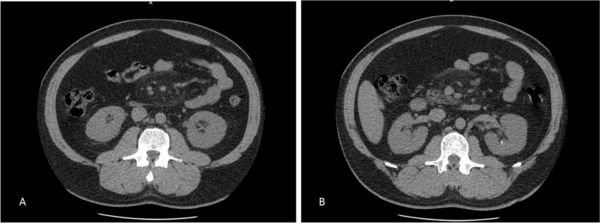 Association between mesenteric panniculitis and urolithiasis