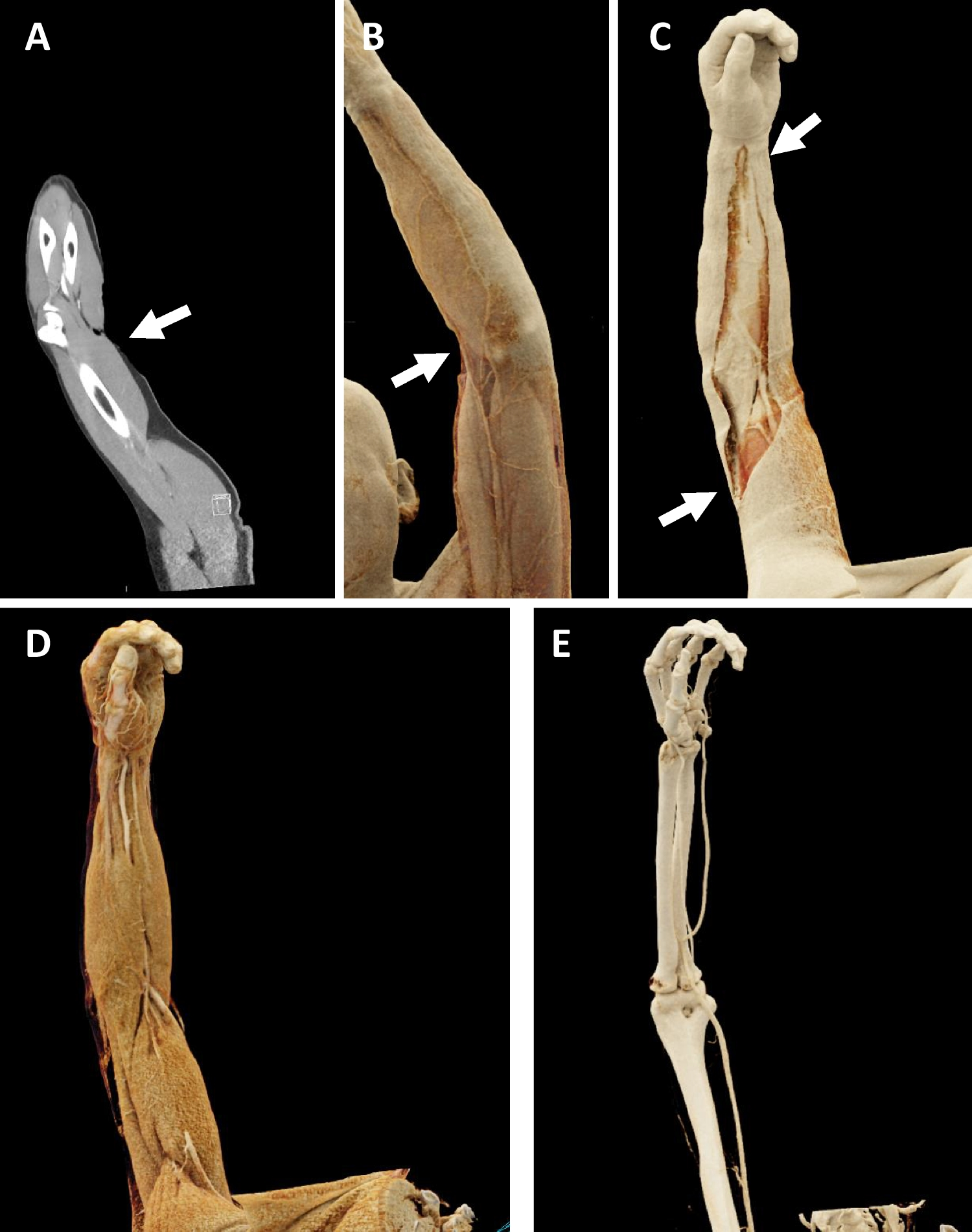 The role of 3D cinematic rendering in the evaluation of upper extremity trauma
