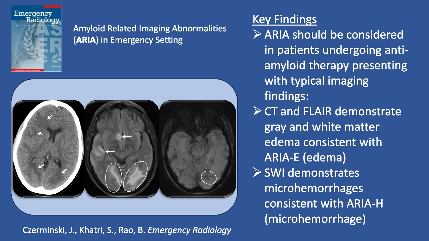 Amyloid related imaging abnormalities in the emergency setting