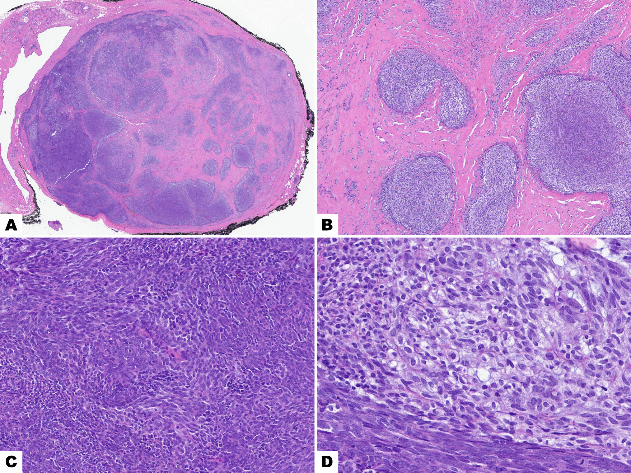 Spindle Epithelial Tumor with Thymus-Like Elements (SETTLE)