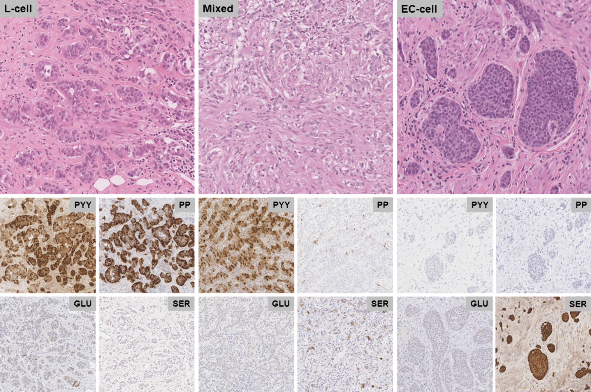 The Clinicopathological Significance of Tumor Cell Subtyping in Appendiceal Neuroendocrine Tumors: A Series of 135 Tumors