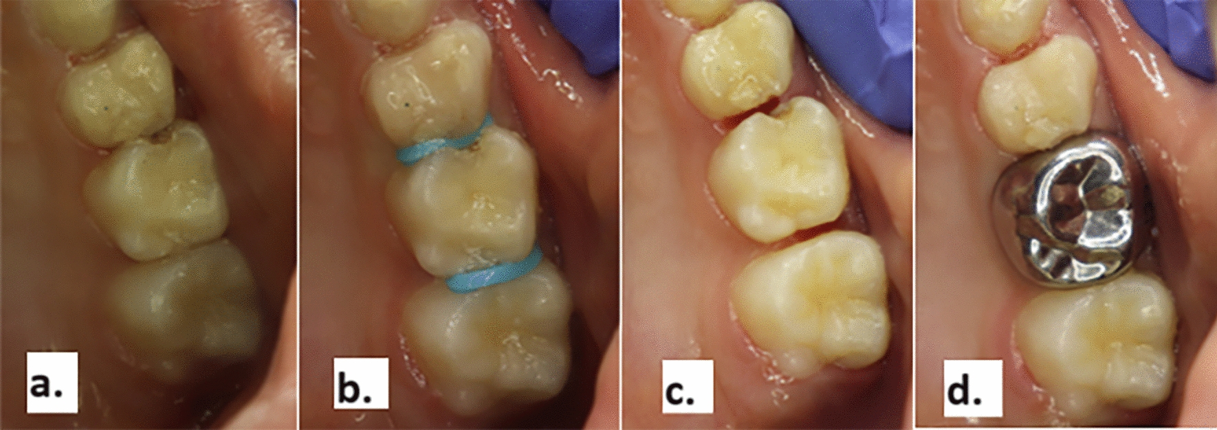 Assessment of masticatory performance in pediatric patients receiving preformed crowns by Hall technique: a controlled clinical trial