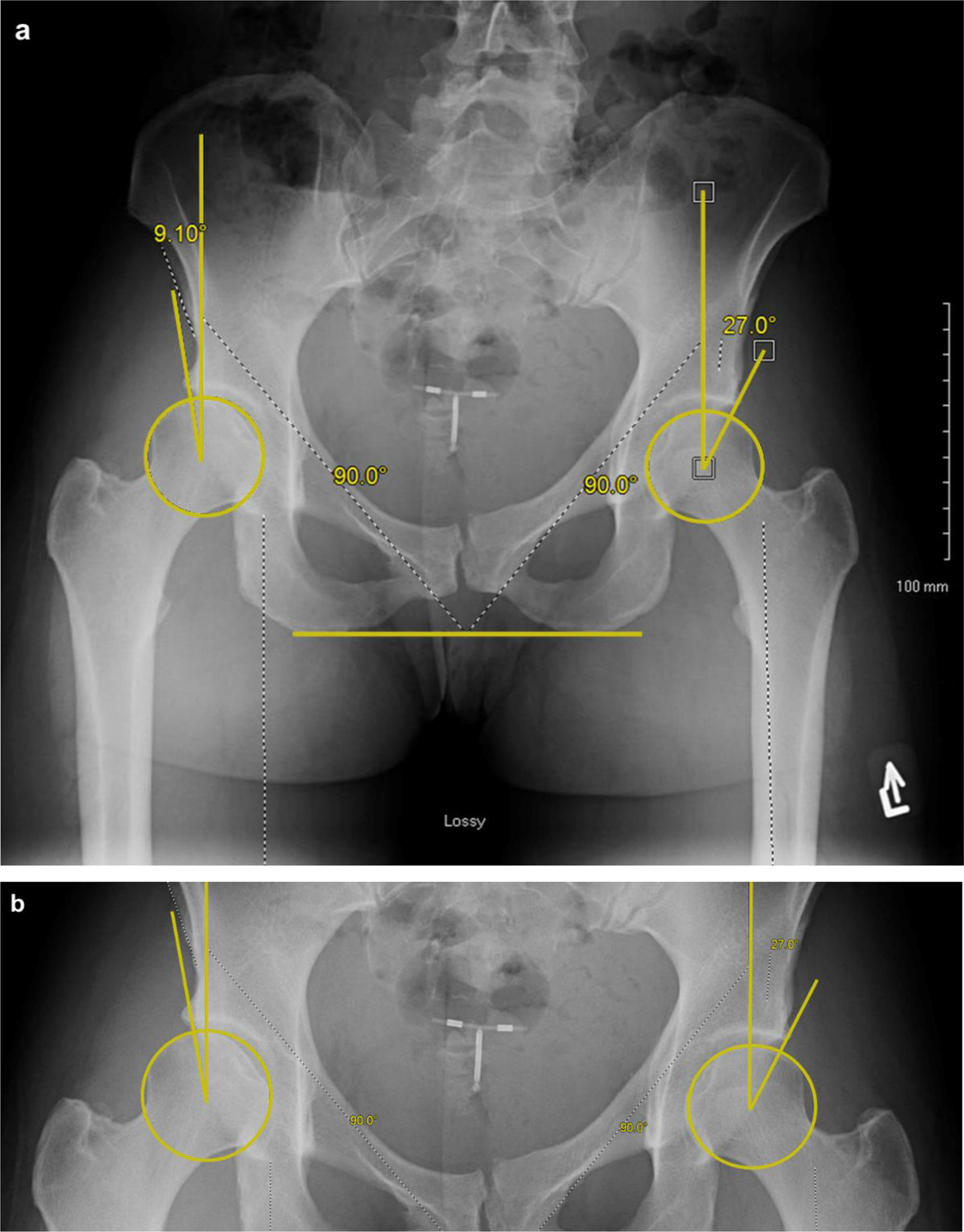 Borderline Hip Dysplasia - Best Treated with Hip Arthroscopy or Periacetabular Osteotomy?