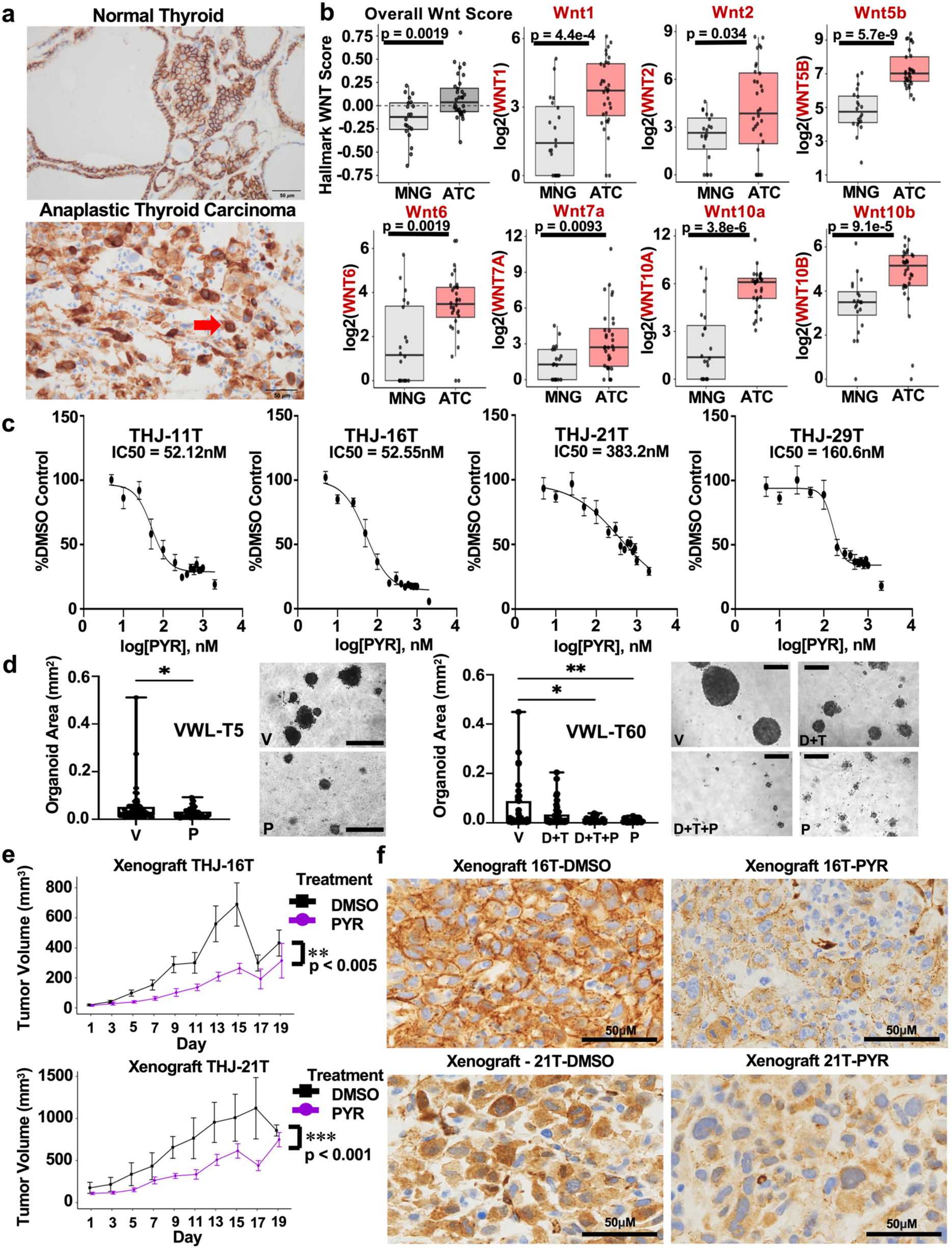 Wnt/β-catenin signaling is a therapeutic target in anaplastic thyroid carcinoma