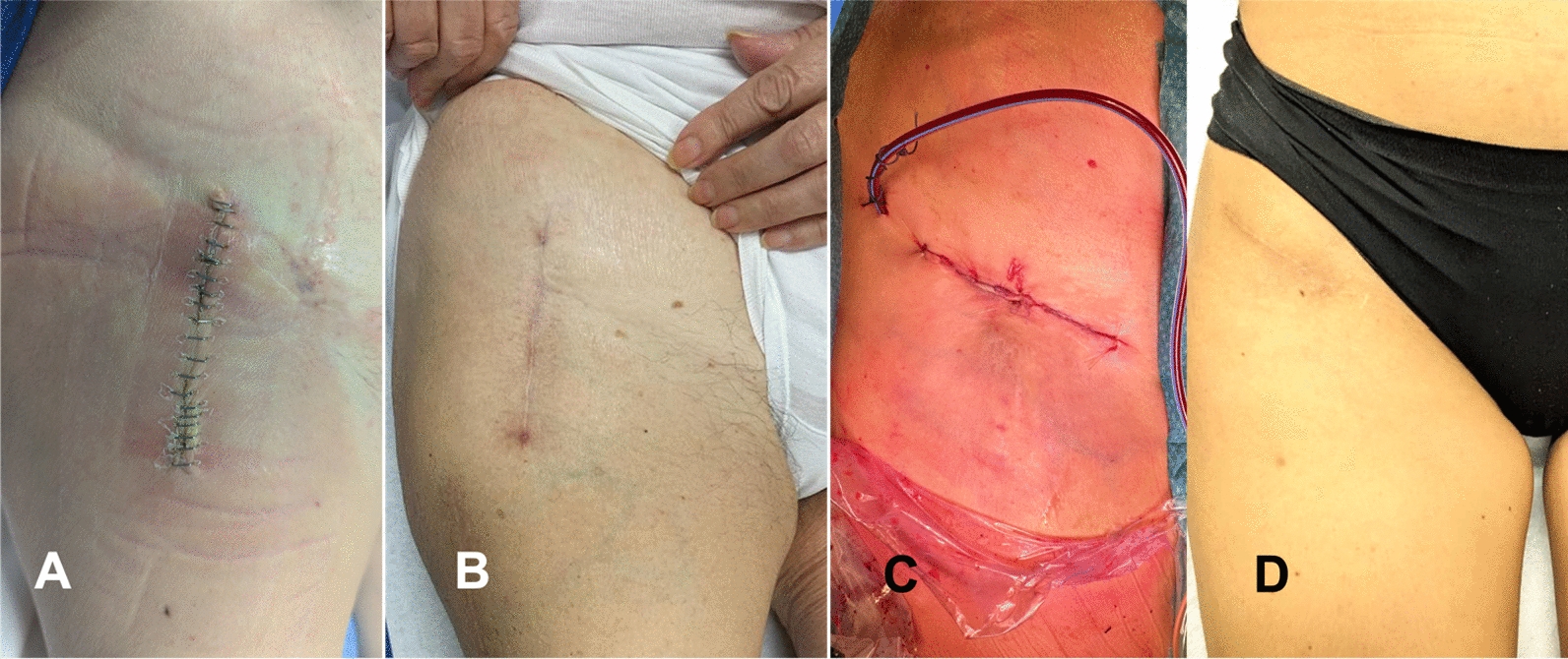 Enhancing recovery: surgical techniques and rehabilitation strategies after direct anterior hip arthroplasty