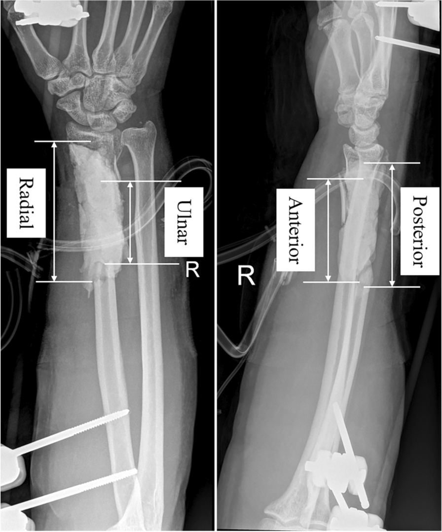 Comparison of free vascularized fibular grafts and the Masquelet technique for the treatment of segmental bone defects with open forearm fractures: a retrospective cohort study