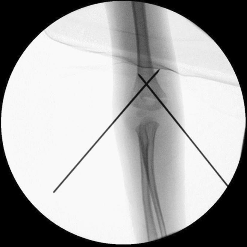Medium-term clinical results in the treatment of supracondylar humeral fractures in children: does the surgical approach impact outcomes?