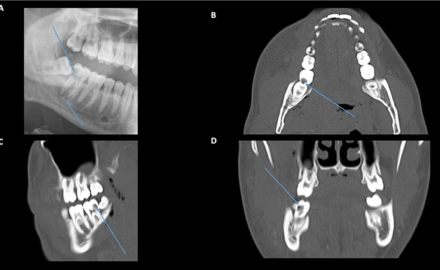 Clinical and radiological characteristics of odontogenic orbital cellulitis
