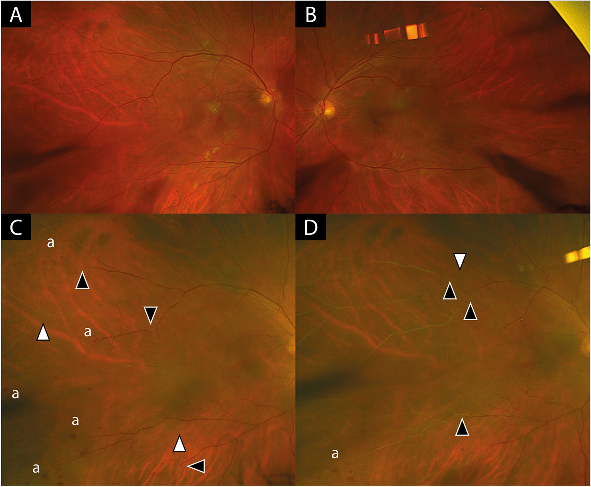 Occlusive retinal vasculitis associated with intravitreal Faricimab injections