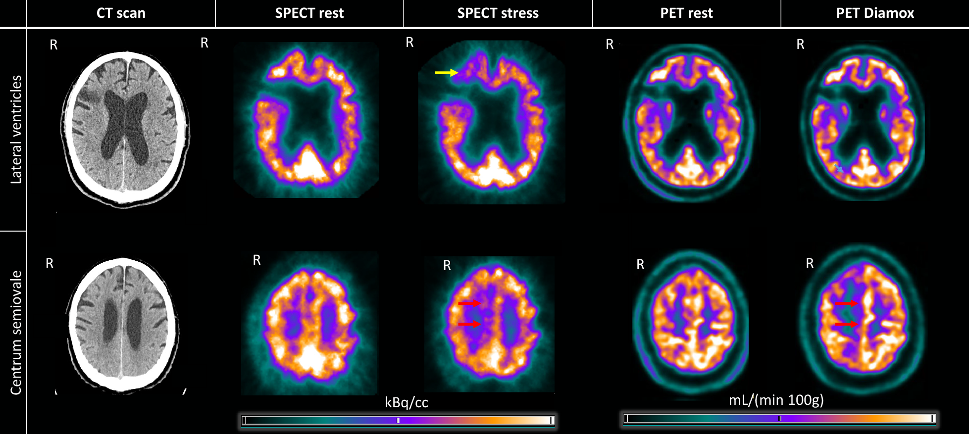 Physiological provocation compared to acetazolamide in the assessment of cerebral hemodynamics: a case report