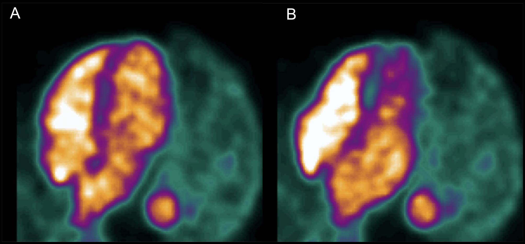 Quantitation of mitral regurgitation using positron emission tomography