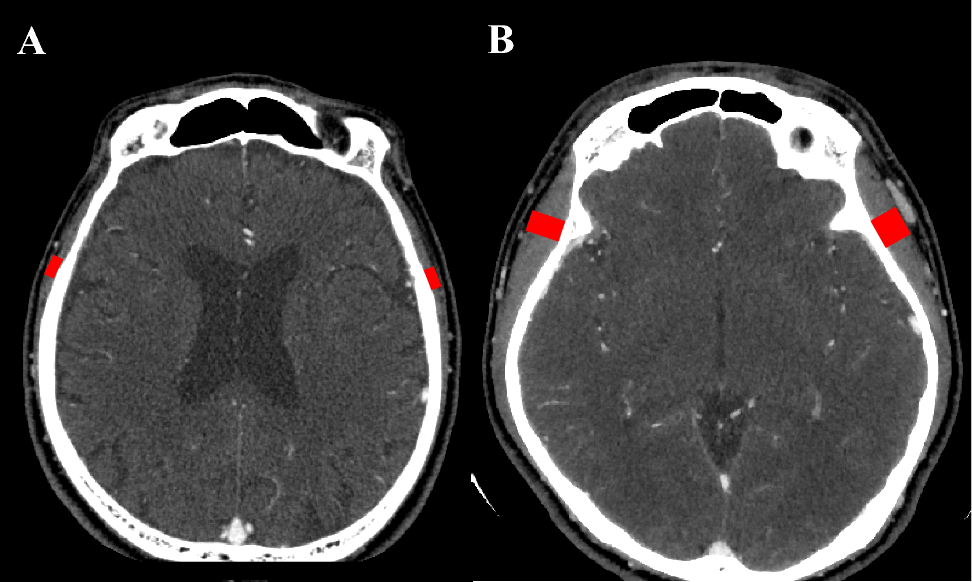 Prognostic value of pretreatment temporal muscle thickness after curative surgery for oral cavity squamous cell carcinoma