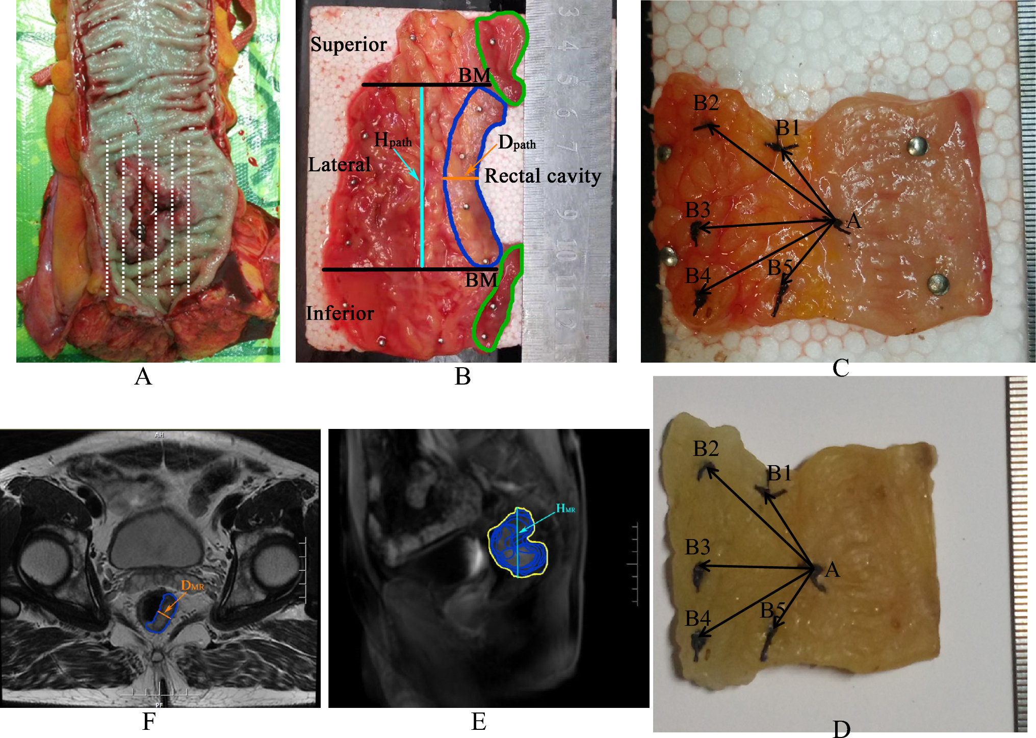 Measurement of the distance between tumor micro-foci and gross tumor in rectal cancer pathological specimens: implication on margin distance of clinical target volume treated with high-dose radiotherapy for rectal cancer
