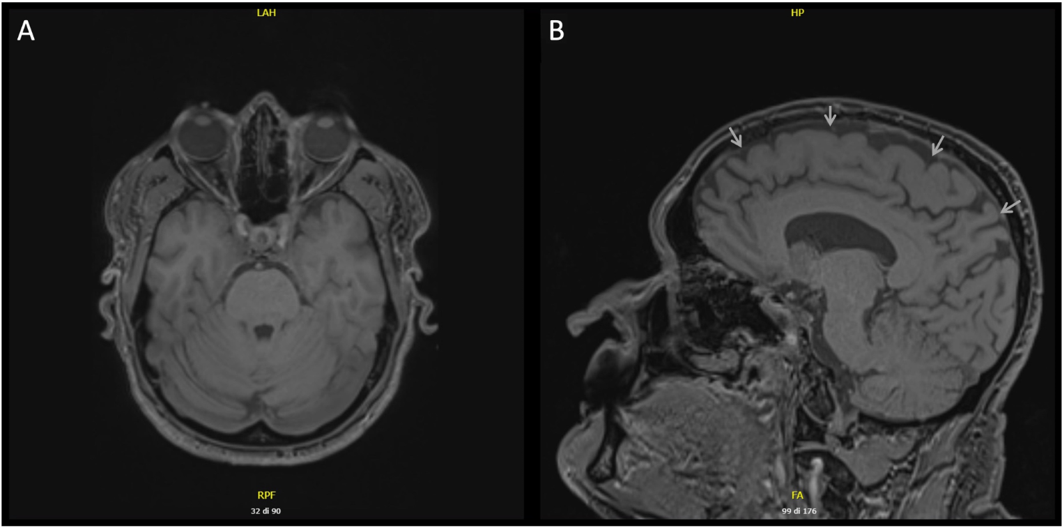 CACNA1G Causes Dominantly Inherited Myoclonus-Ataxia with Intellectual Disability: A Case Report