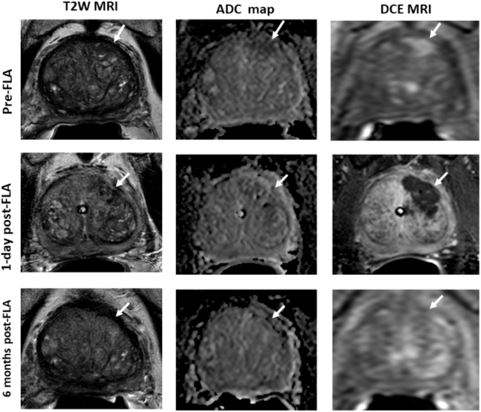 Surveillance after Focal Therapy – a Comprehensive Review
