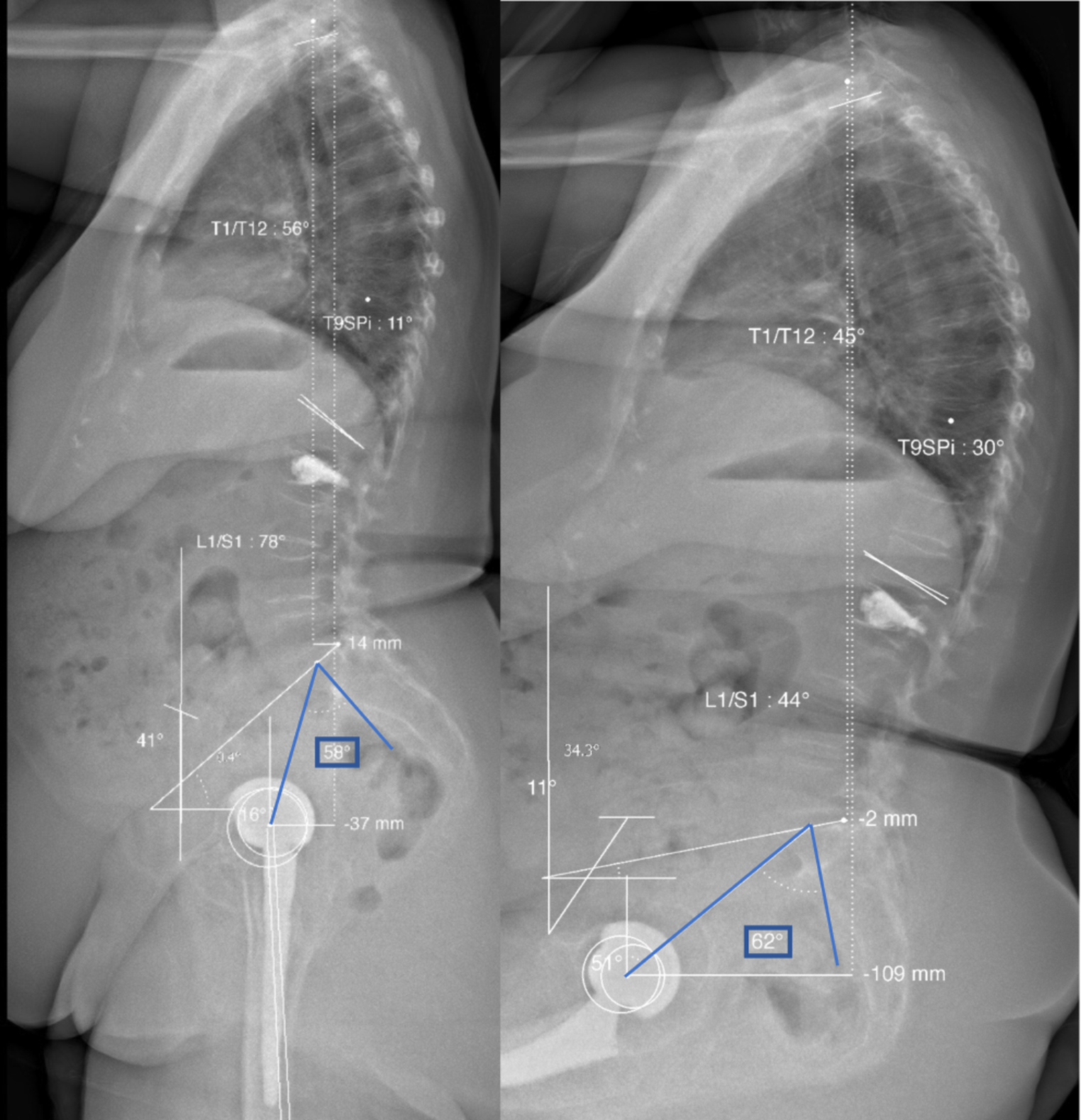 Sacroiliac pain after total hip arthroplasty: a combined analysis of clinical data and three-dimensional imaging in standing and sitting positions
