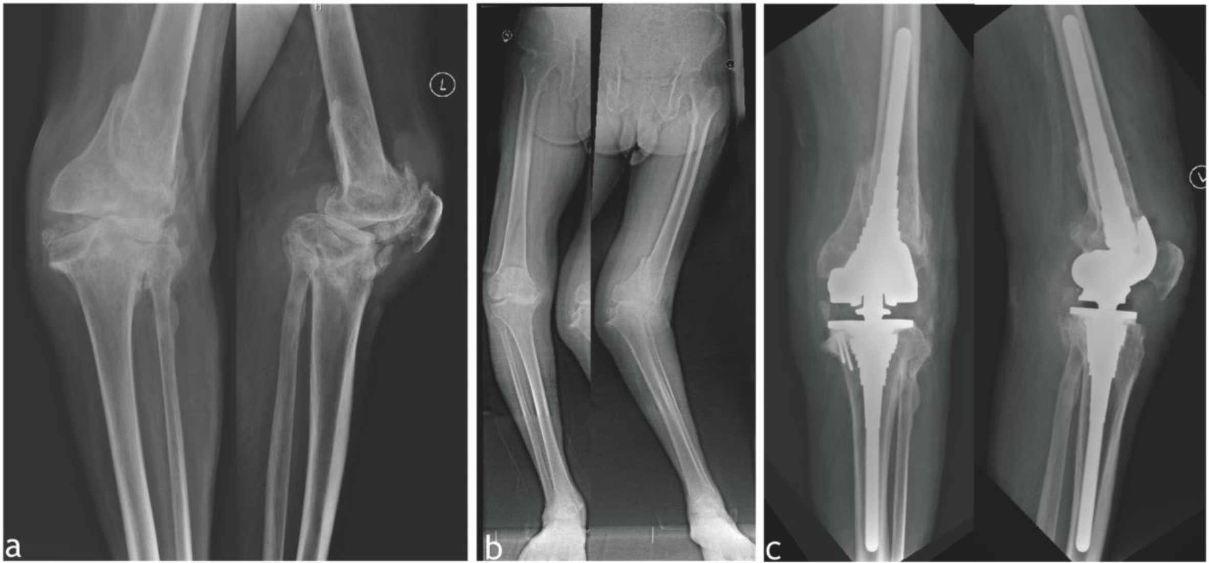 Clinical outcomes of primary total knee arthroplasty in non-syphilitic neuroarthropathy of the knee