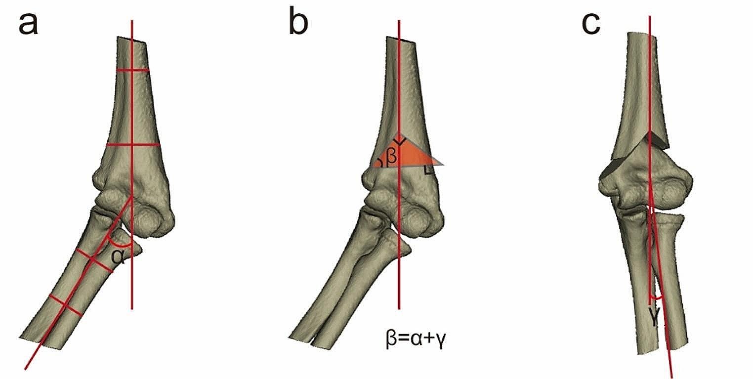 Step-cut osteotomy for cubitus varus deformity with application of patient-specific instrument in children: a preliminary report
