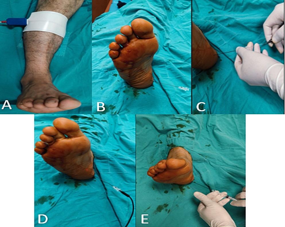 Innovative approaches in the treatment of chronic plantar fasciitis: comparison of pulsed radiofrequency ablation and surgical intervention