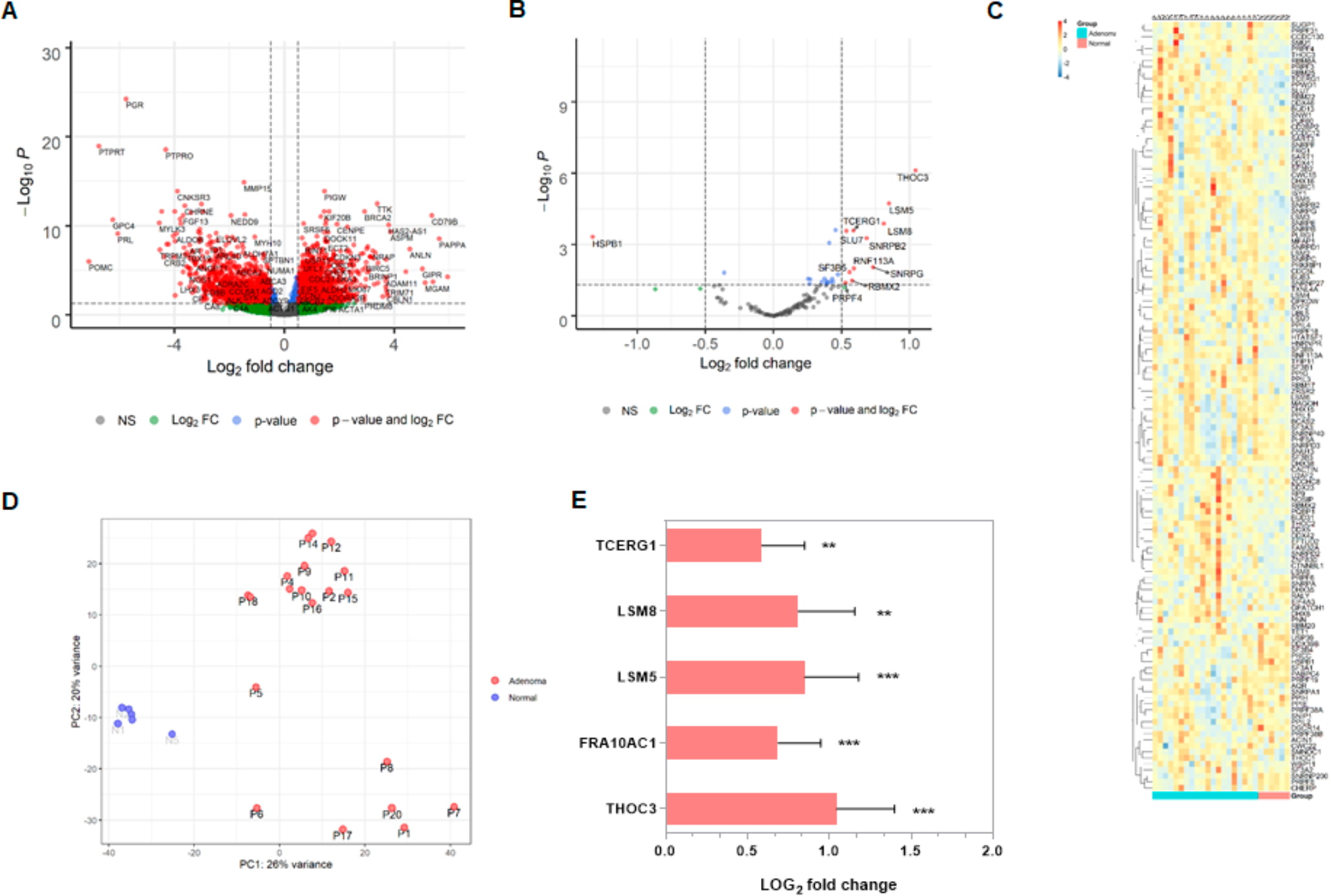 Spliceosome component TCERG1 regulates the aggressiveness of somatotroph adenoma