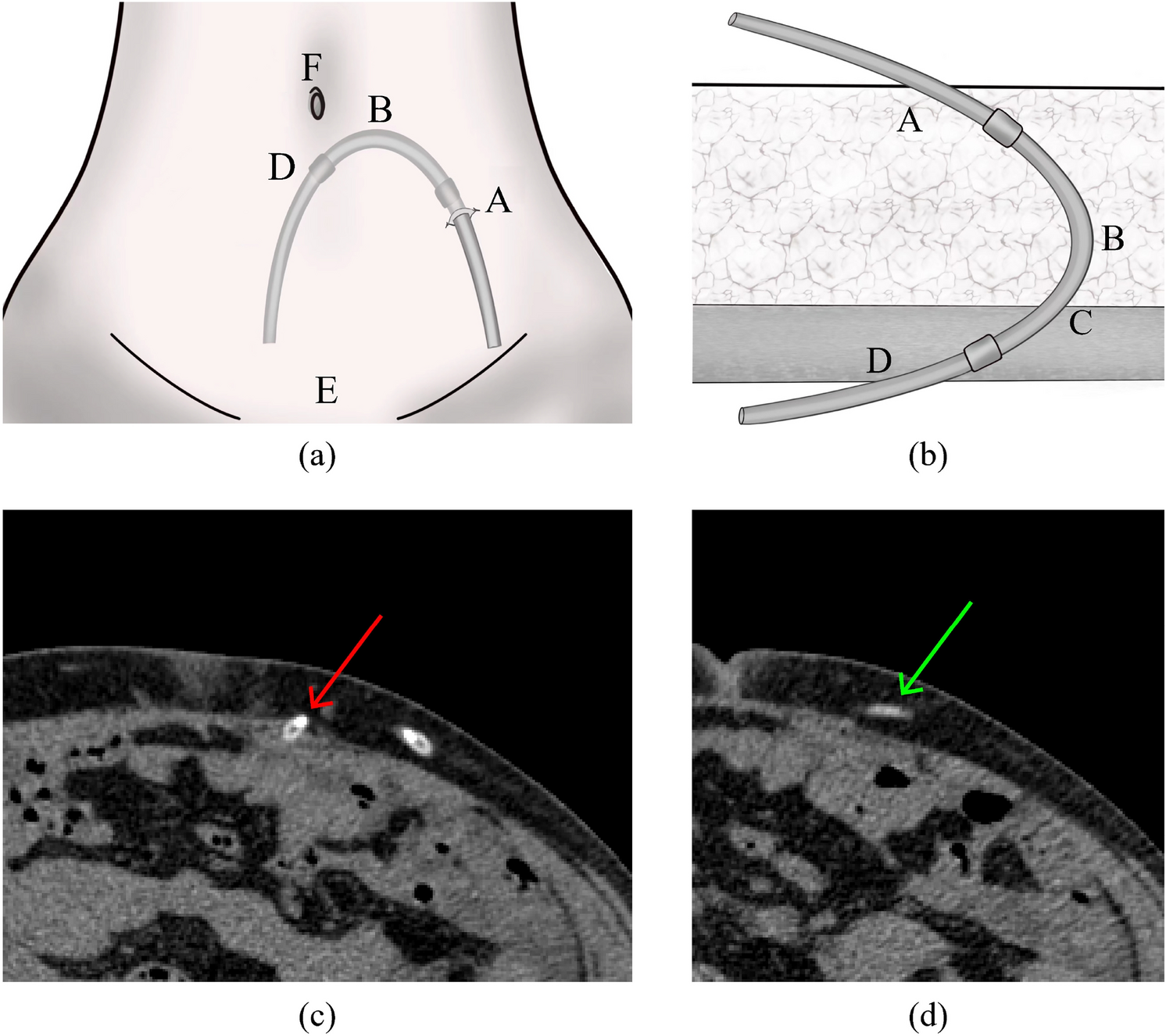 CT data analysis of catheter morphology and displacement in peritoneal dialysis: an exploratory study