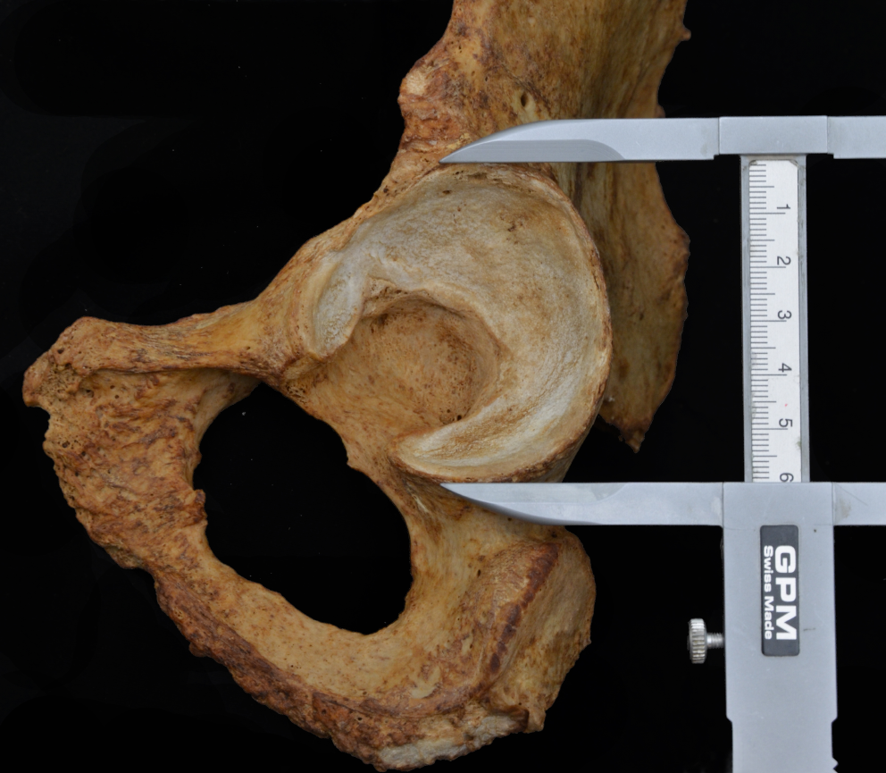 A statistical evaluation of the sexual dimorphism of the acetabulum in an Iberian population