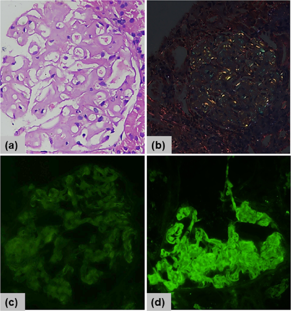 “Light Chain Amyloidosis with Extensive Deposition in Bone Marrow Aspirate Smears”