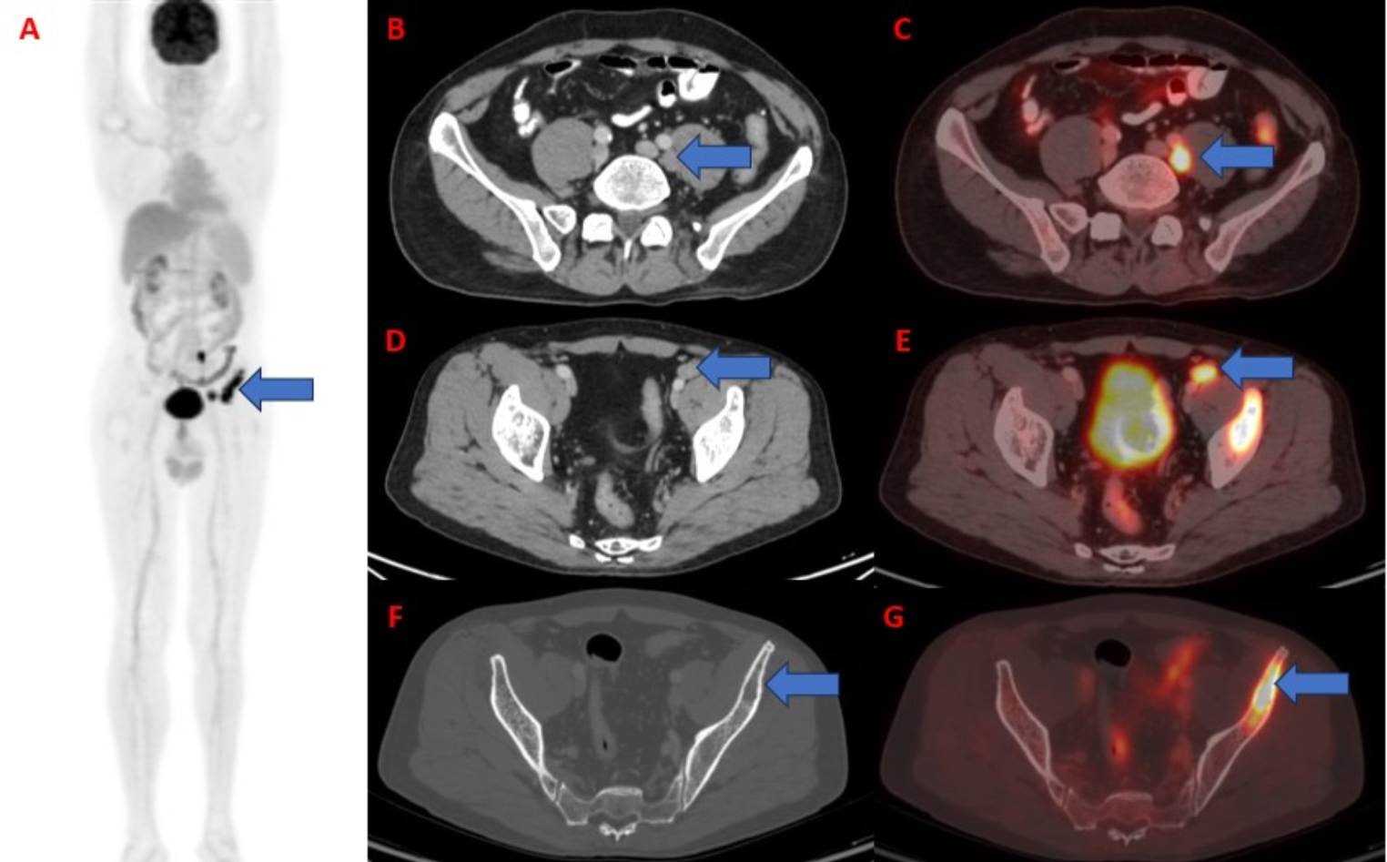 F18-FDG PET/CT Imaging in a Rare Case of Solitary Primary Iliac Bone Lymphoma