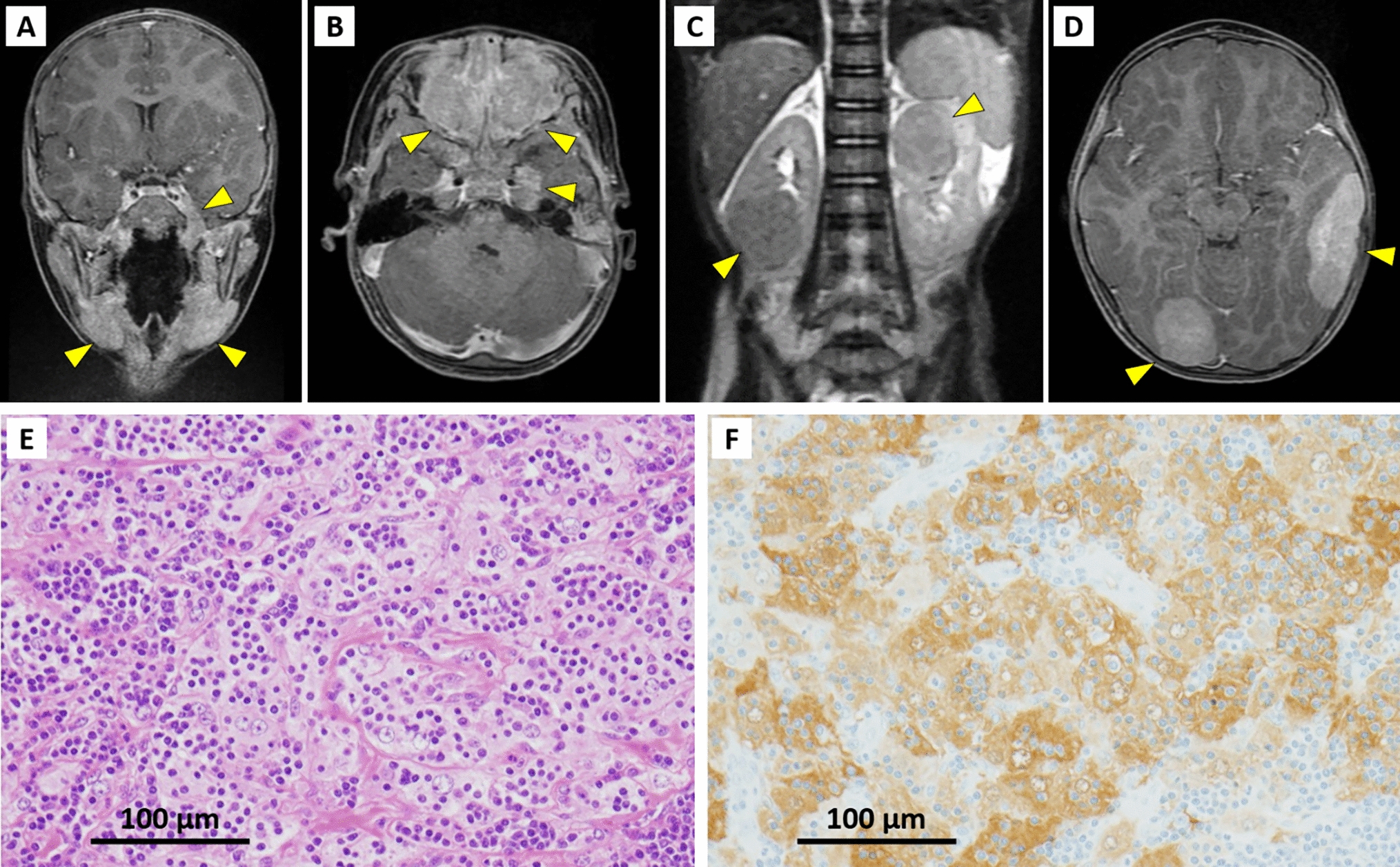 Trametinib for a child with refractory Rosai–Dorfman–Destombes disease harboring a novel somatic mutation in MAP2K1