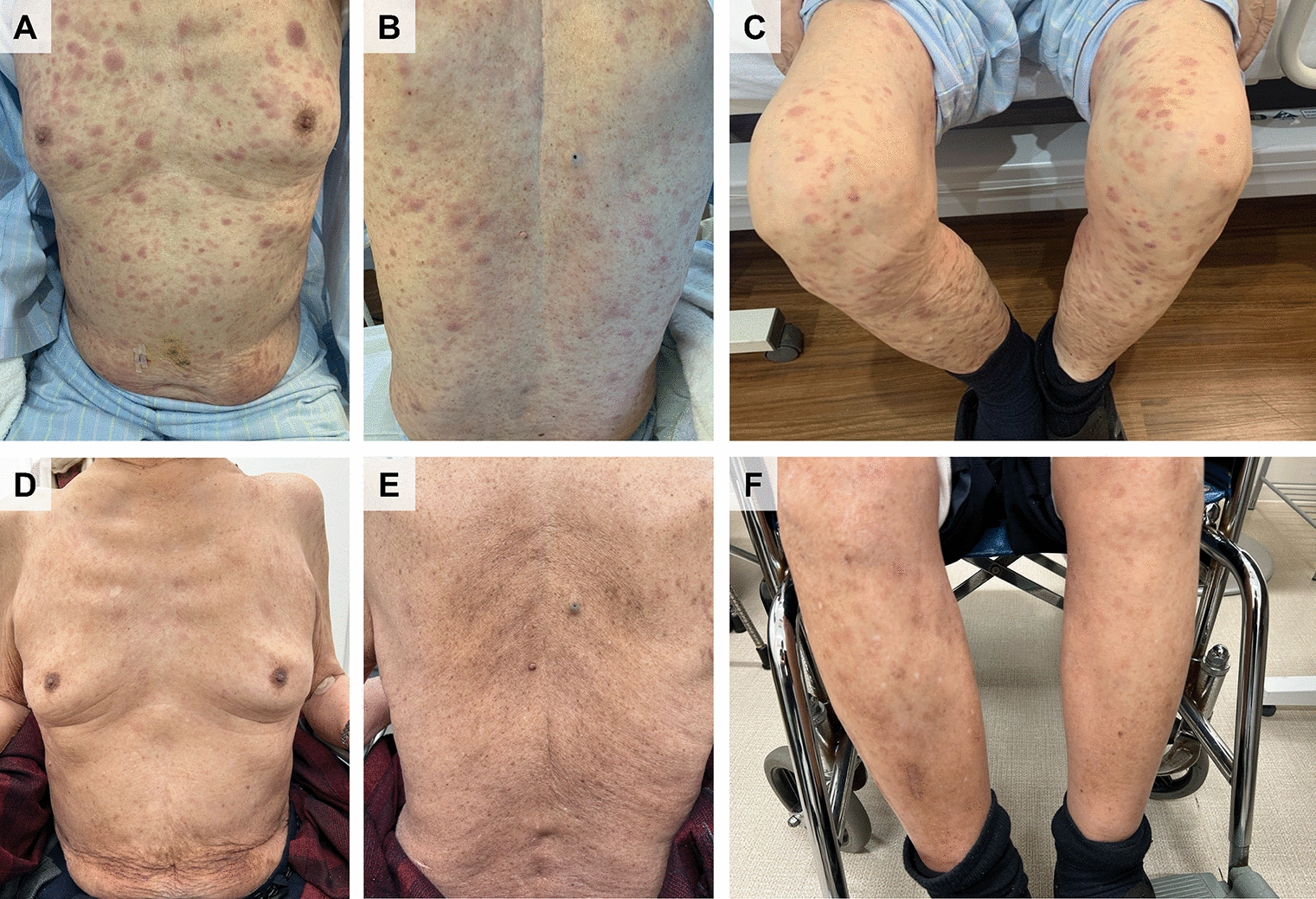 Immunohistochemical differentiation of extramedullary acute myeloid leukemia from blastic plasmacytoid dendritic cell neoplasm