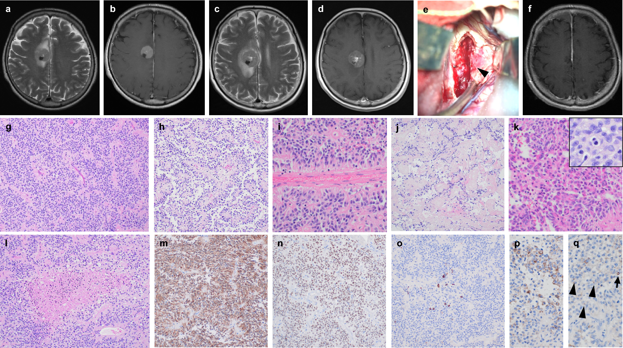 Astroblastoma with MN1::BEND2 in an elderly patient: A case report and review of the literature