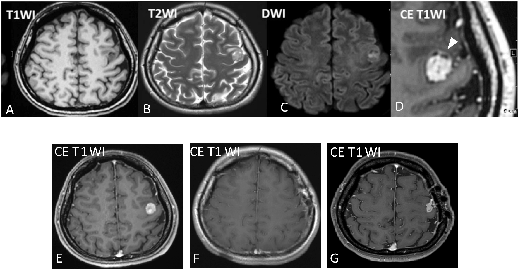 Novel case of ependymoma-like tumor with mesenchymal differentiation harboring ZFTA::RELA fusion in an adult