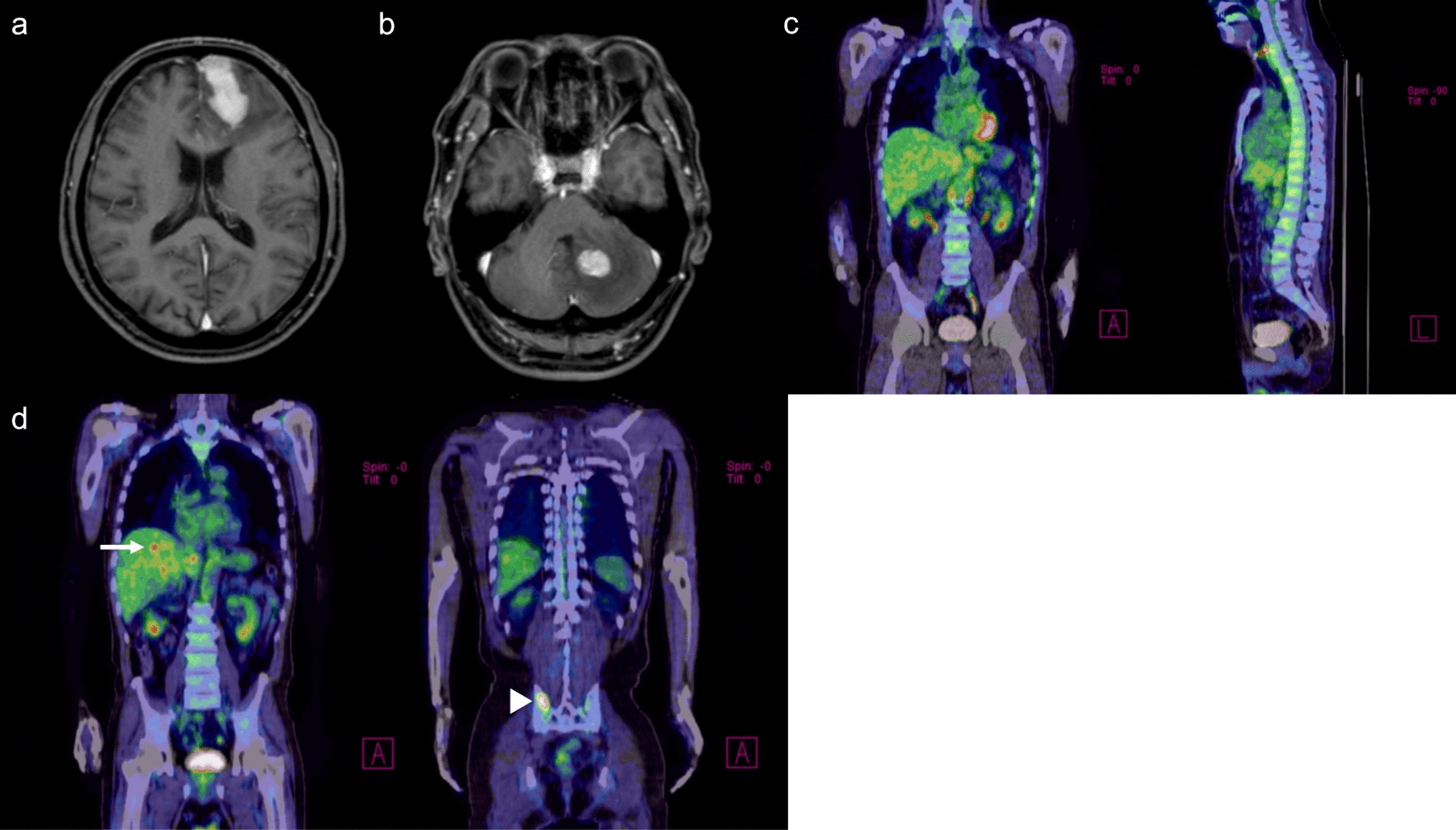 Double-hit primary central nervous system lymphoma with histogenetically proven bone marrow infiltration: a case report and a review of the literature