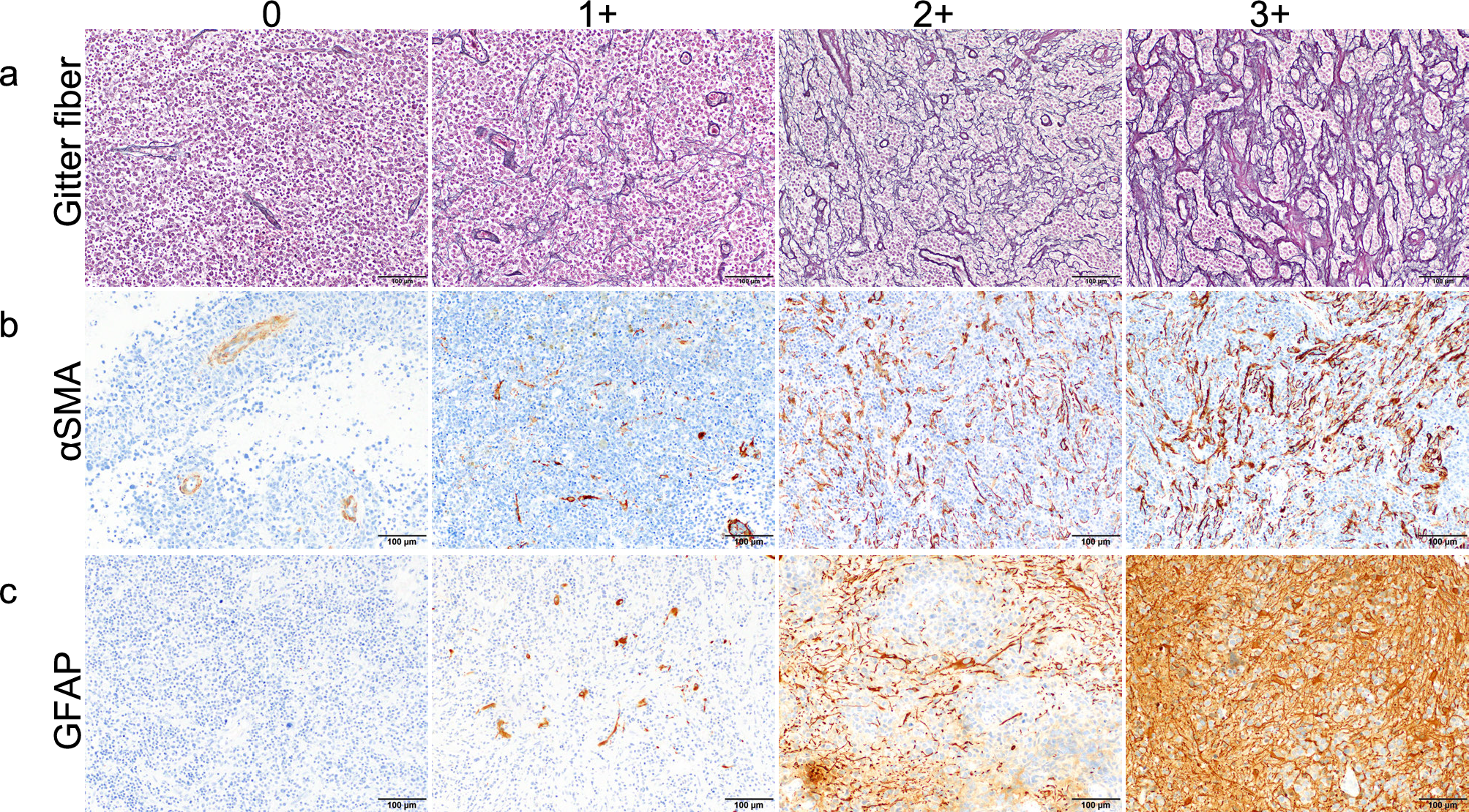 Comparative analyses of immune cells and alpha-smooth muscle actin-positive cells under the immunological microenvironment between with and without dense fibrosis in primary central nervous system lymphoma