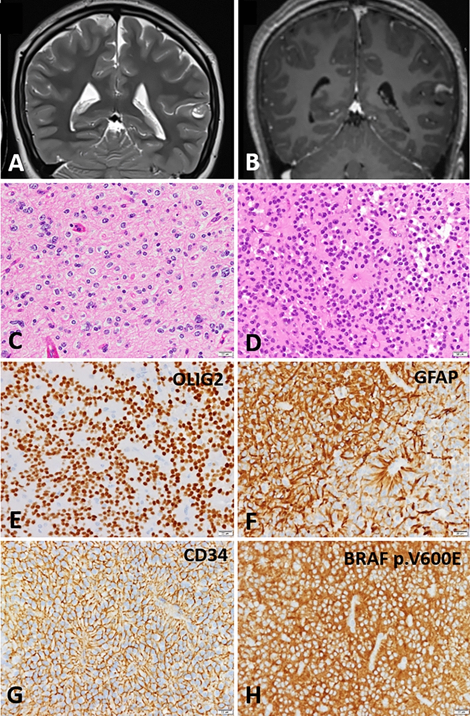 MAPK pathway alterations in polymorphous low-grade neuroepithelial tumor of the young: diagnostic considerations