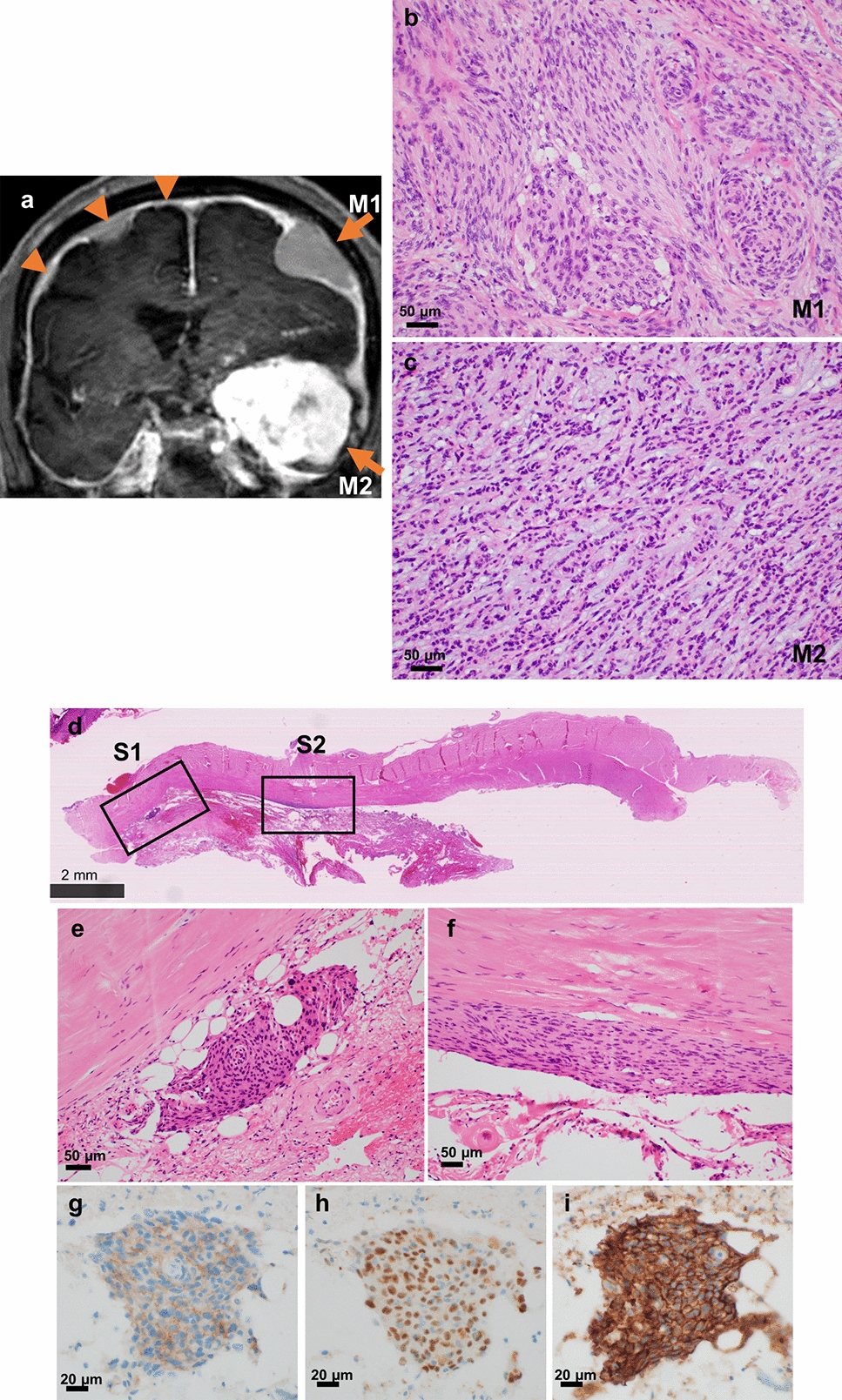 Comprehensive genomic analysis reveals clonal origin and subtype-specific evolution in a case of sporadic multiple meningiomas
