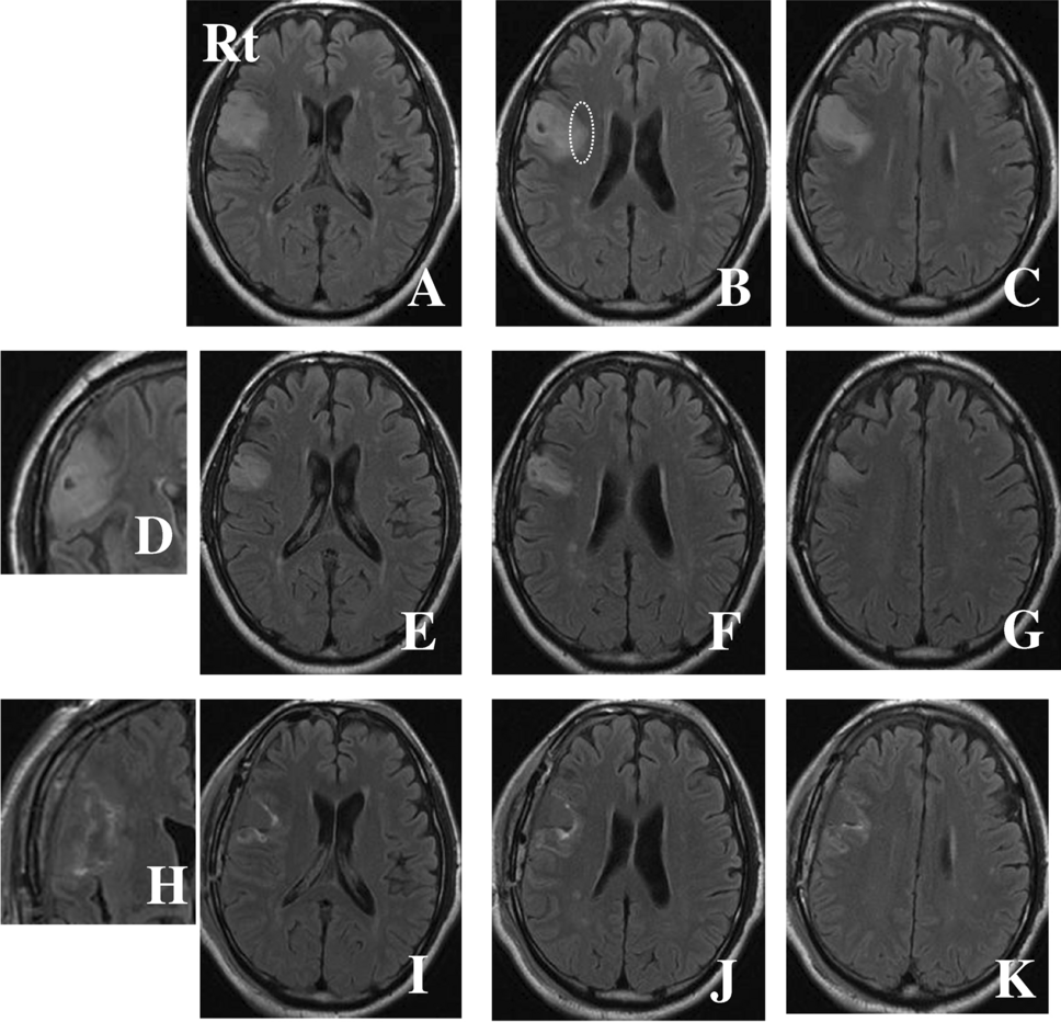 Oligodendroglioma, IDH-mutant and 1p/19q-codeleted-prognostic factors, standard of care and chemotherapy, and future perspectives with neoadjuvant strategy