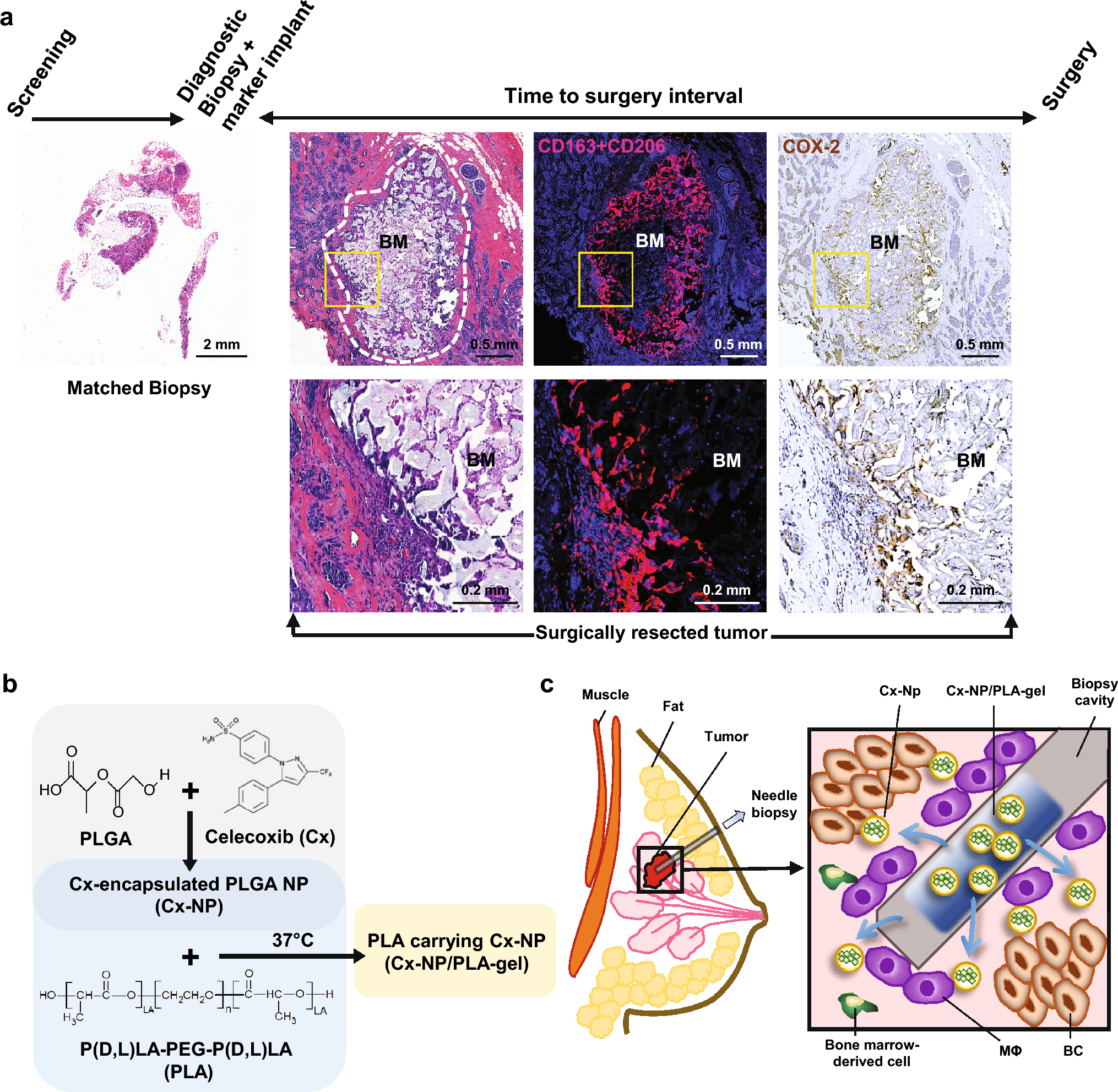 Sustained delivery of celecoxib from nanoparticles embedded in hydrogel injected into the biopsy cavity to prevent biopsy-induced breast cancer metastasis