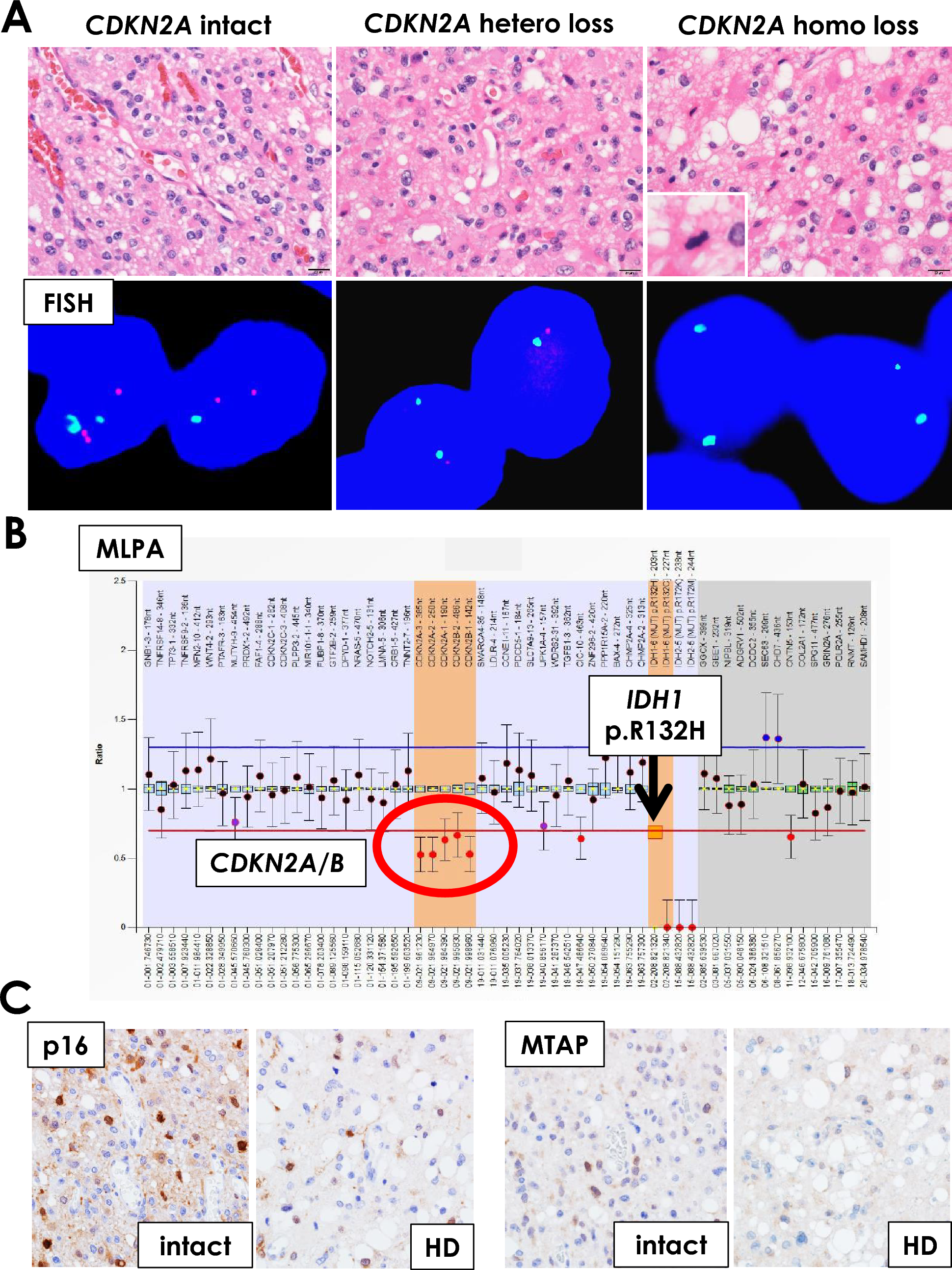 Intratumoral heterogeneity of CDKN2A deletions in IDH-mutant astrocytoma