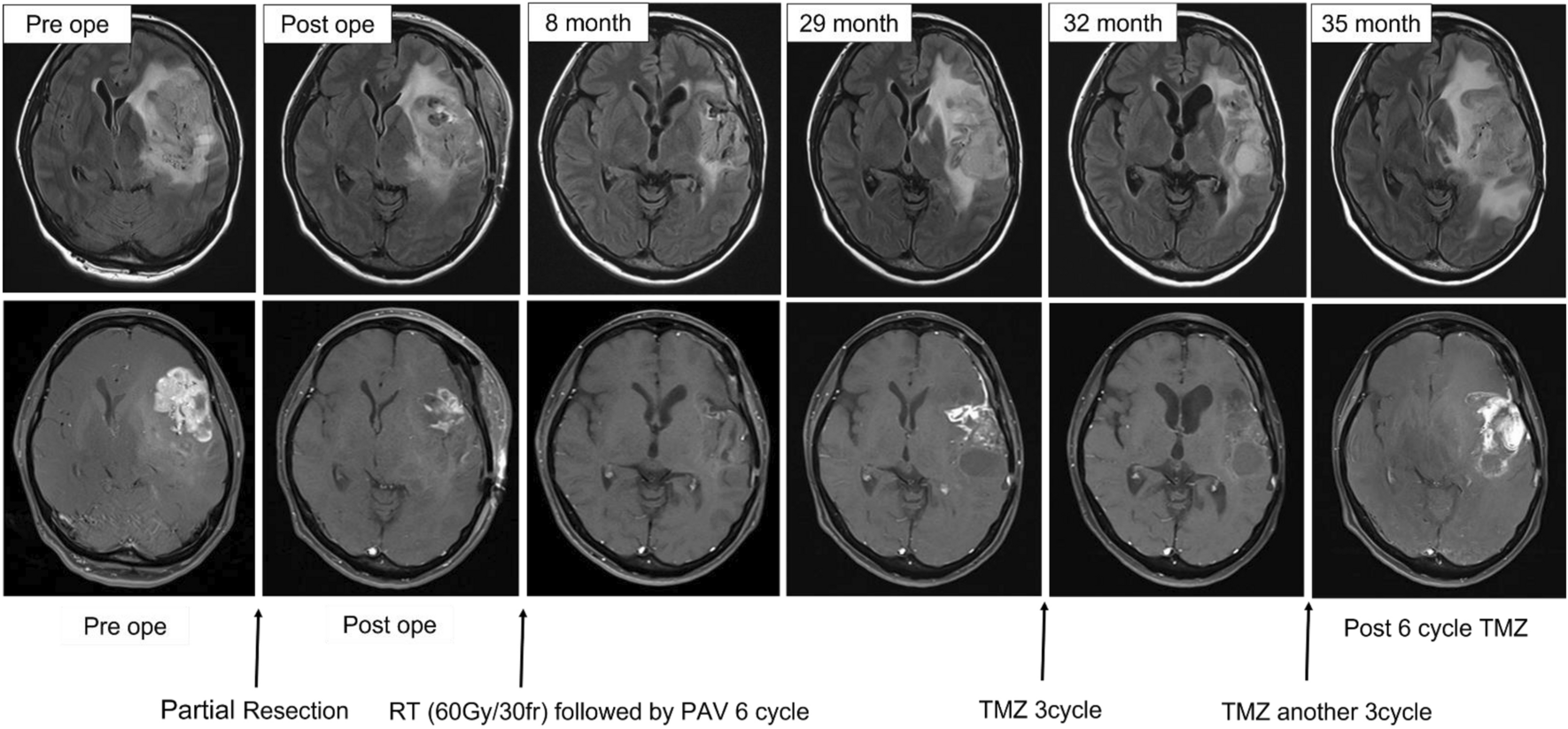 Rise of oligodendroglioma hypermutator phenotype from a subclone harboring TP53 mutation after TMZ treatment