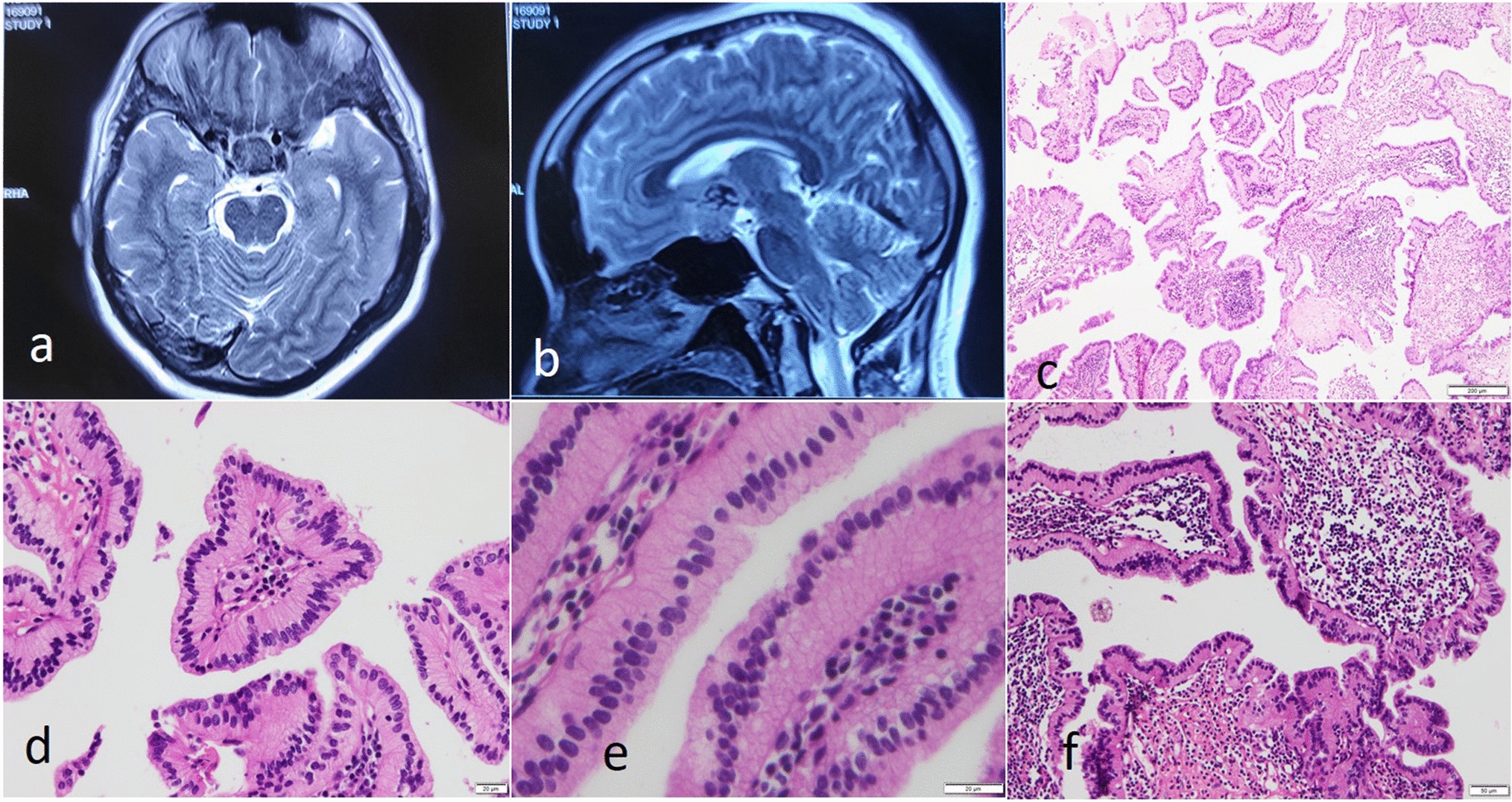 Primary papillary epithelial tumor of the sella: a case report of an emerging tumor type