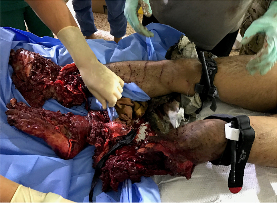 Damage Control in Vascular Trauma